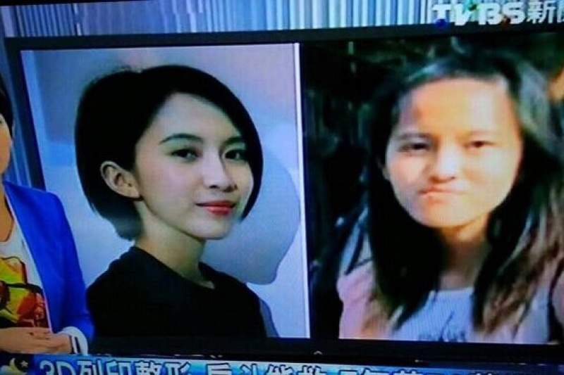 3D打印正颚手术|台湾恐龙妹7年花70万变身超级美女
