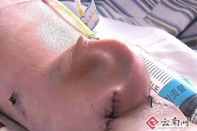 厉害了！昆明医院用3D打印在患者手臂上“种”出耳朵    再移植