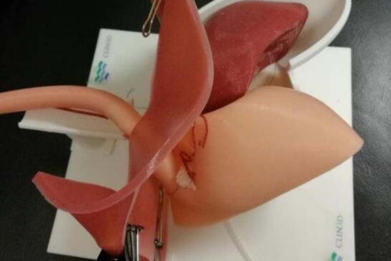 浙江医生利用高仿真3D打印人体器官，解决胃食道返流难题