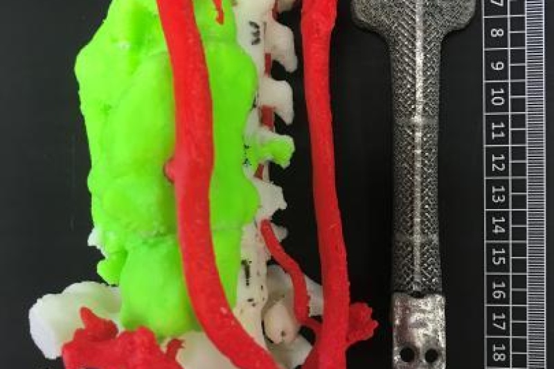 上海医院成功实施首例6节段颈椎切除术，植入3D打印的14厘米钛合金椎体