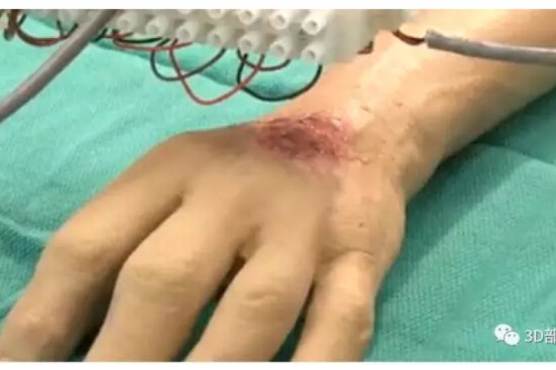 【干货分享】论生物打印在皮肤组织工程中的应用