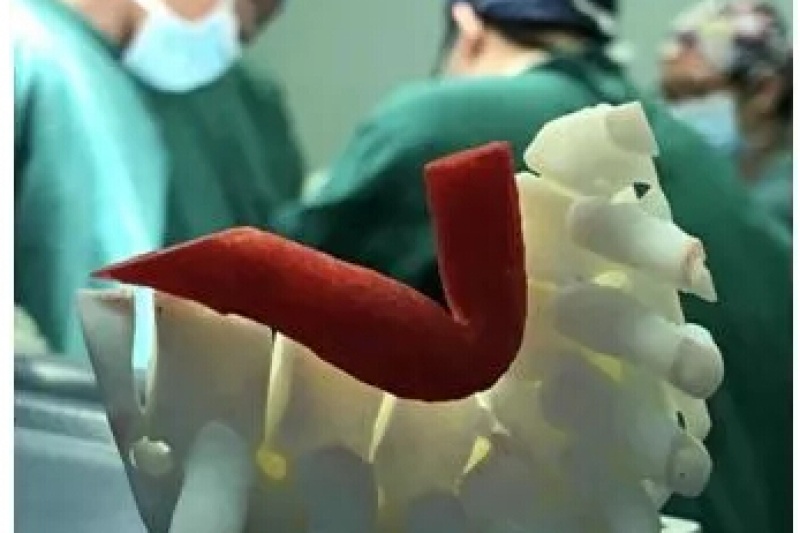 三的部落3D打印助力脊柱后凸矫正手术术前规划
